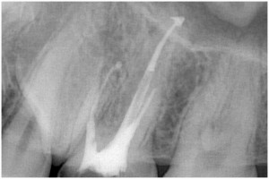 小坂２　根管充填